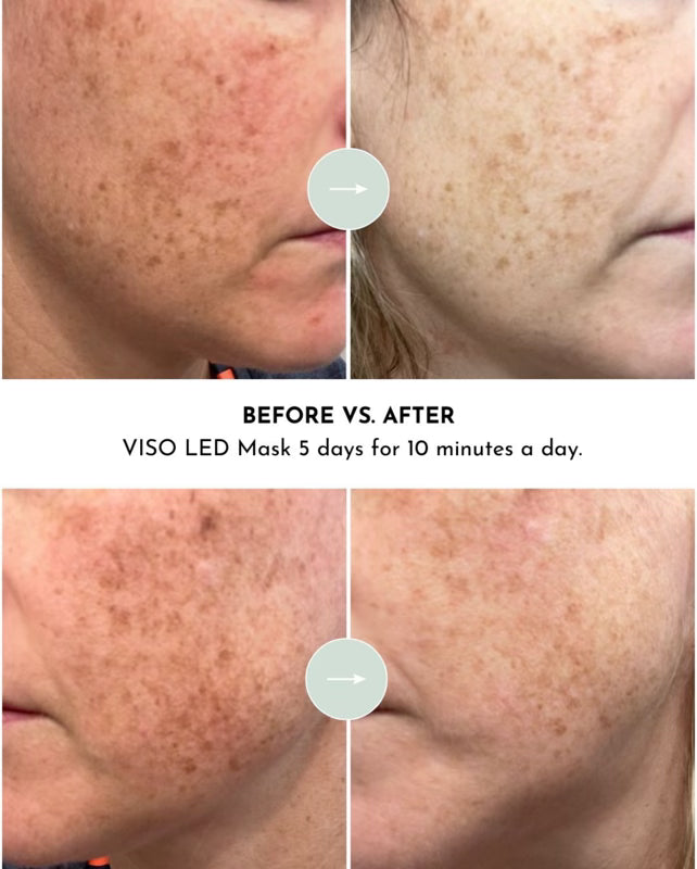 VISO - FDA Certified Red Light Therapy Mask